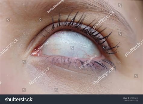 Eye of Dead