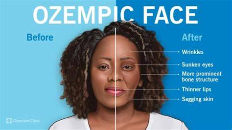 Using ozempic can help reduce acne and fine lines